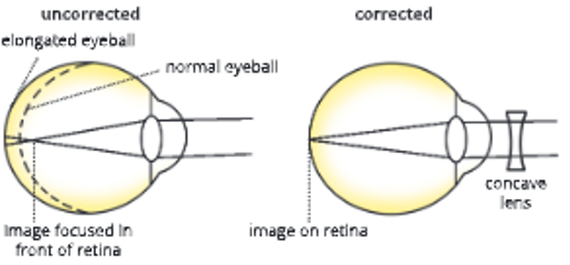 sense organs short sightedness an image formed in front of the retina