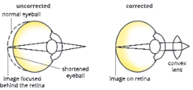 sense organs long sightedness an image formed behind the retina 10