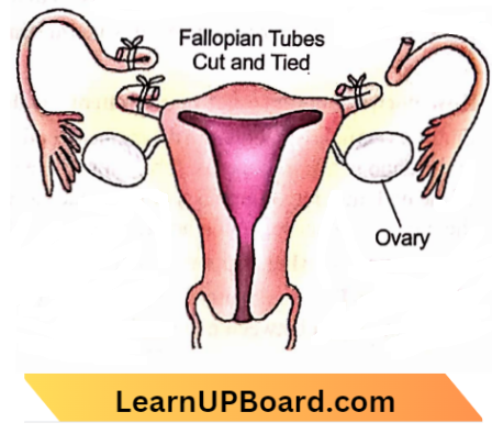 Sexual Reproduction Tubectomy