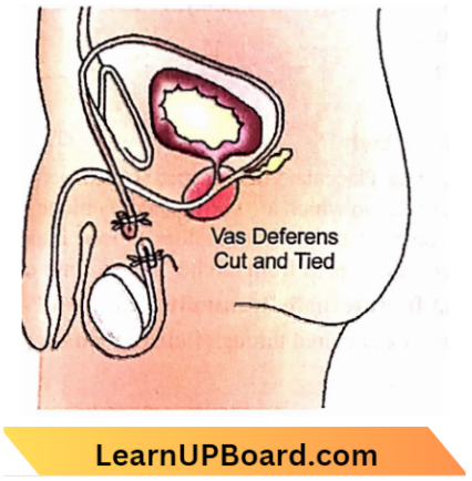 Sexual Reproduction Vasectomy